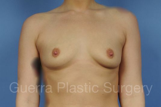 Case #1001172 Before