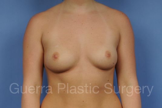 Case #1001174 Before