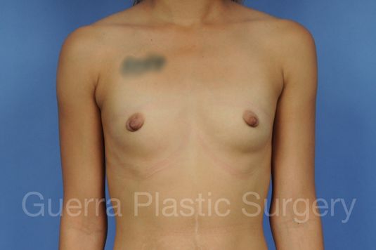 Case #1002152 Before