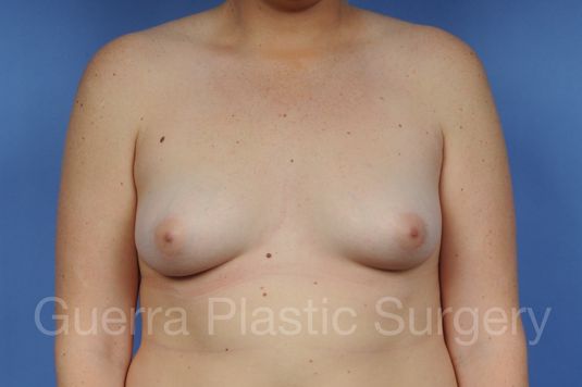 Case #1003021 Before