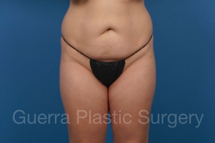 Before Photo Tummy Tuck