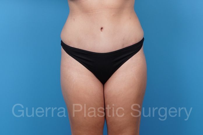 After Photo Tummy Tuck