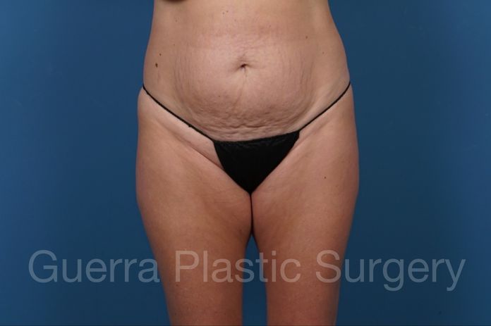 Before Photo Tummy Tuck