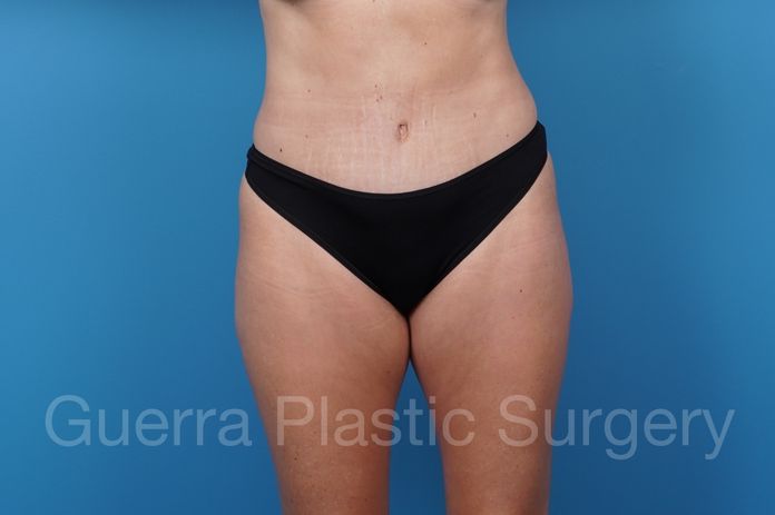 After Photo Tummy Tuck