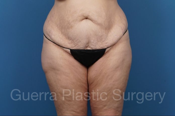 Before Photo Tummy Tuck