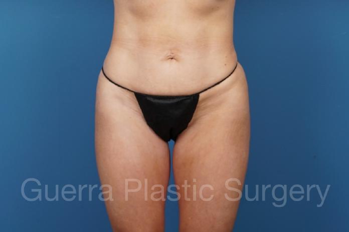 Before Photo Tummy Tuck