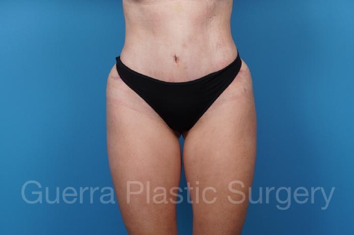 After Photo Tummy Tuck