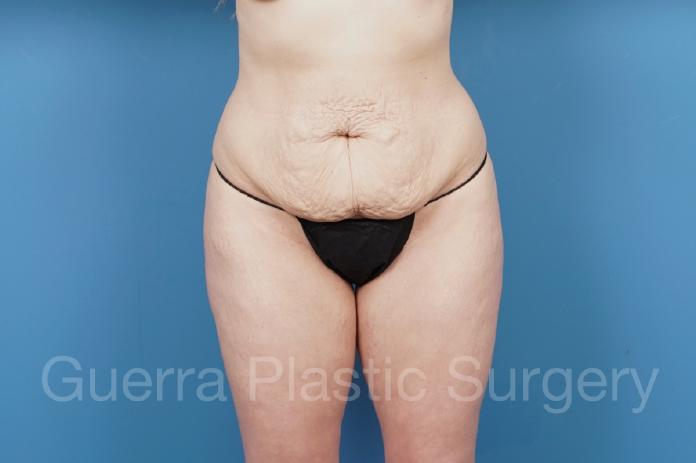 Before Photo Tummy Tuck