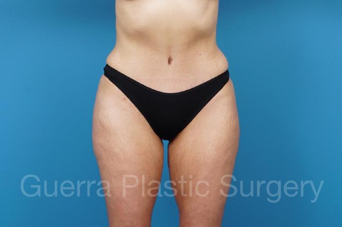 After Photo Tummy Tuck