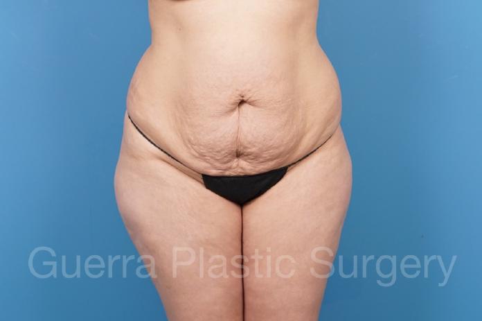 Before Photo Tummy Tuck