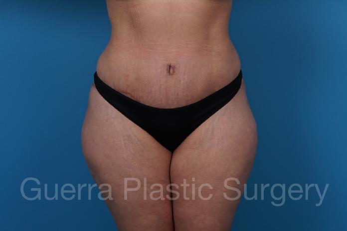 After Photo Tummy Tuck