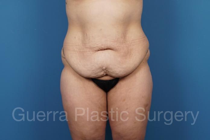 Before Photo Tummy Tuck