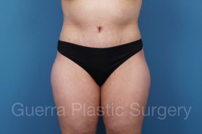 After Photo Tummy Tuck