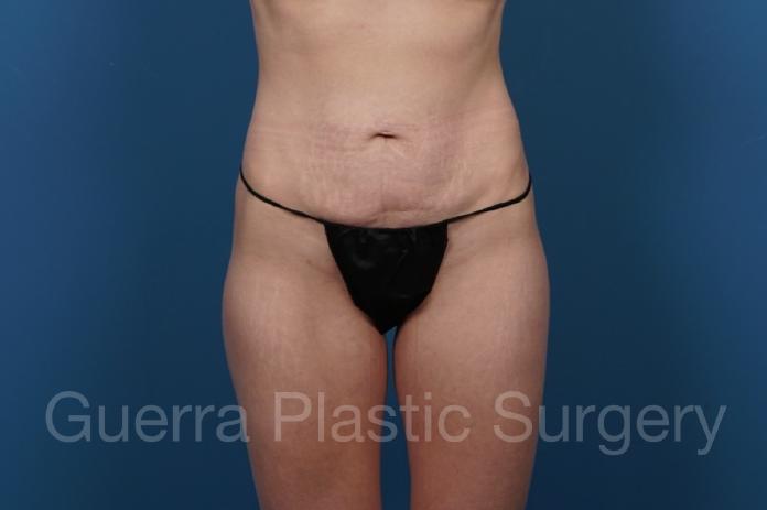 Before Photo Tummy Tuck