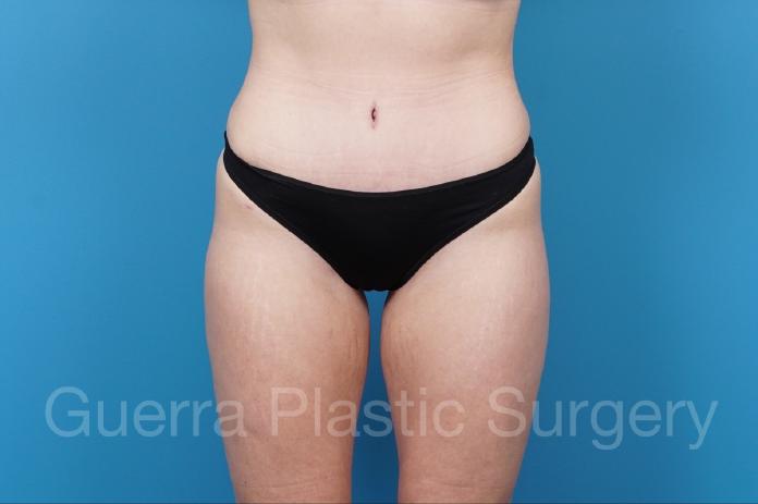 After Photo Tummy Tuck