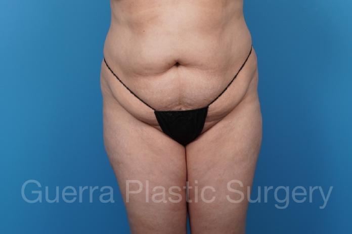 Before Photo Tummy Tuck