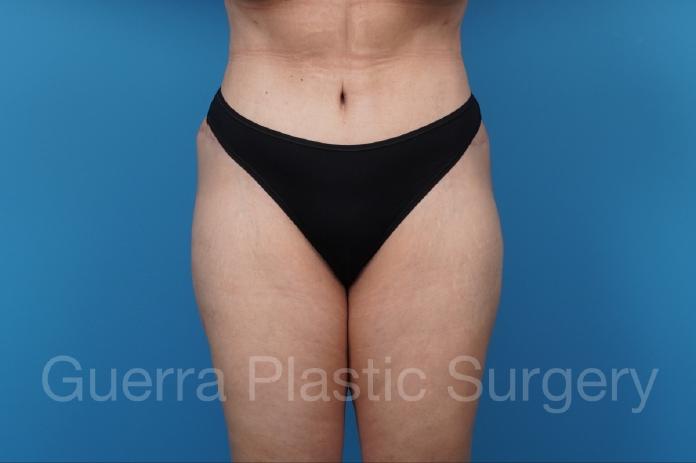 After Photo Tummy Tuck