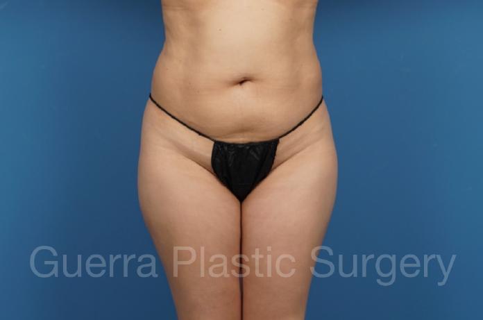 Before Photo Tummy Tuck