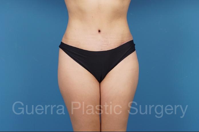 After Photo Tummy Tuck