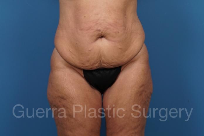 Before Photo Tummy Tuck