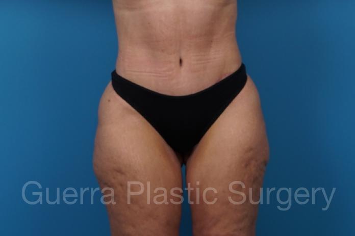 After Photo Tummy Tuck