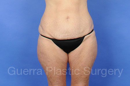 Before Photo Tummy Tuck