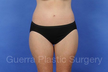 After Photo Tummy Tuck