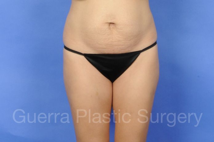 Before Photo Tummy Tuck