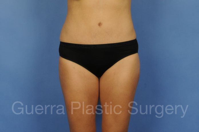 After Photo Tummy Tuck