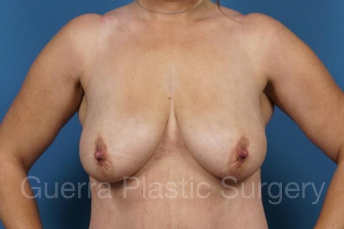 Before Photo Breast Lift / Implant