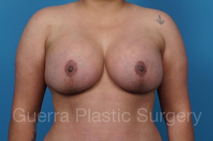 After Photo Breast Lift / Implant