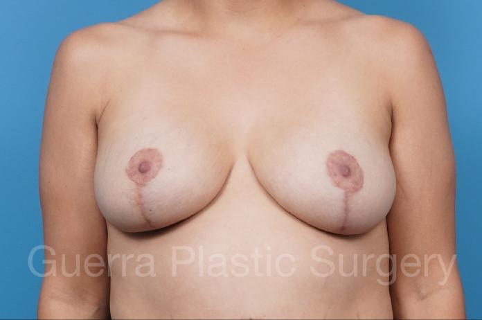 After Photo Breast Lift / Implant