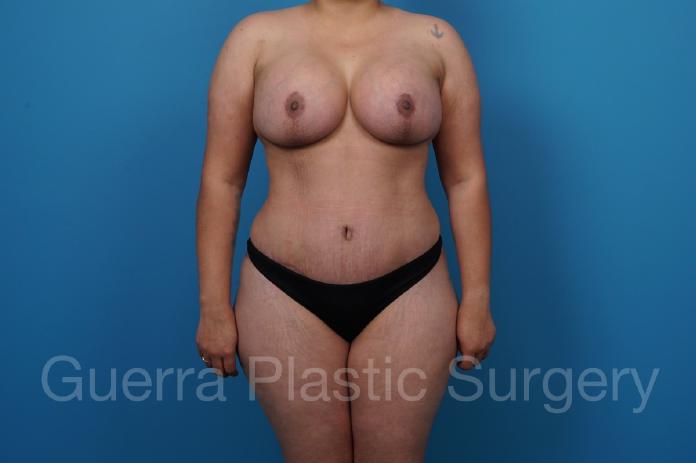 After Photo Tummy Tuck with Breast Lift / Implant