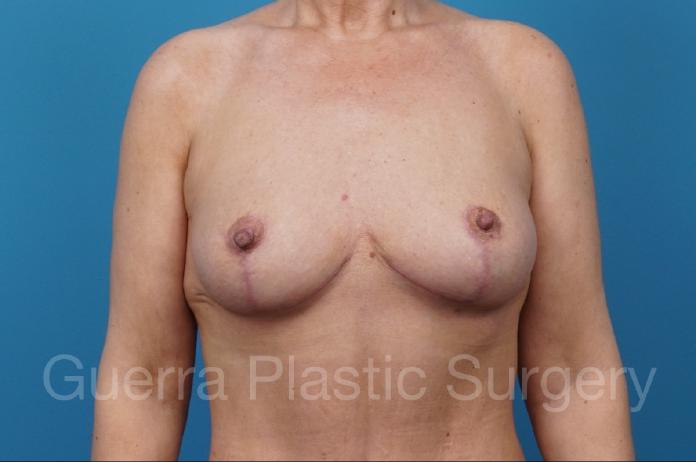 After Photo Breast Lift No Implant