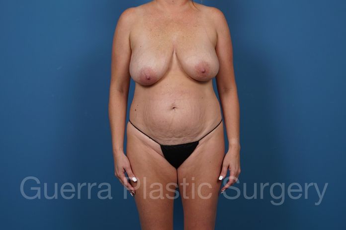 Before Photo Tummy Tuck + Breast Lift No Implant