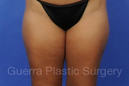 Before Photo Liposuction