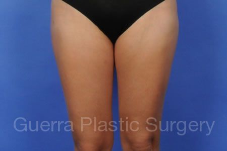 After Photo Liposuction